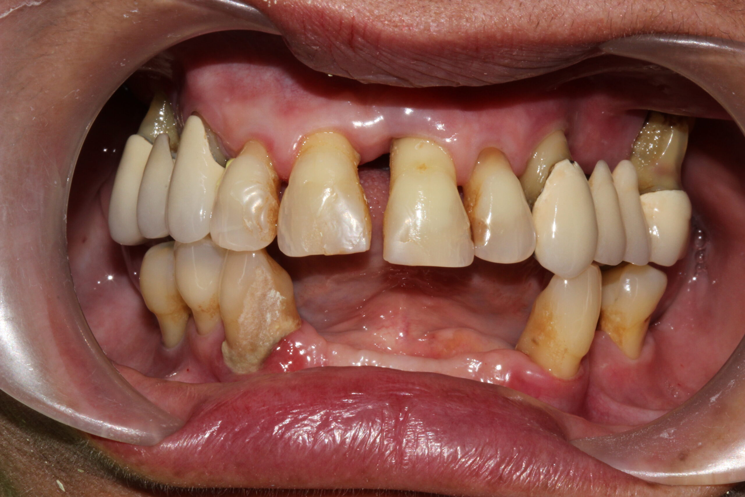 Patient with severe tooth loss and worn teeth before All-on-4 dental implant treatment at Vdent Lima.