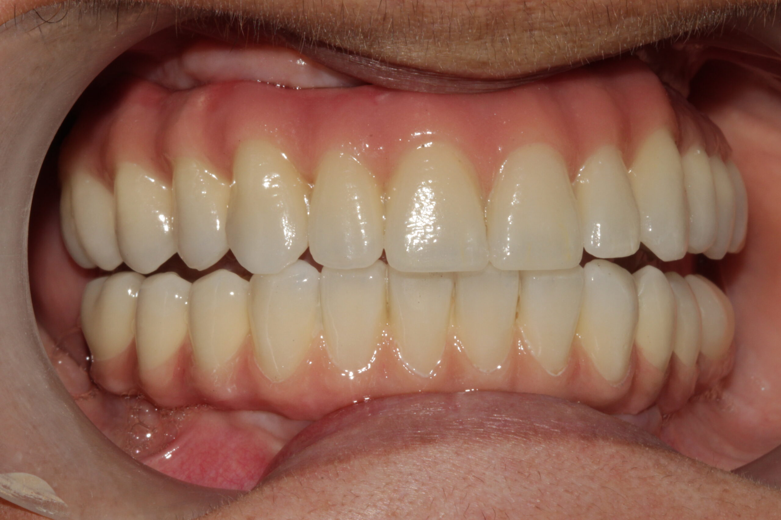 Final result of a fixed dental prosthesis on All-on-4 implants, showing natural aesthetics and healthy gums at Vdent.