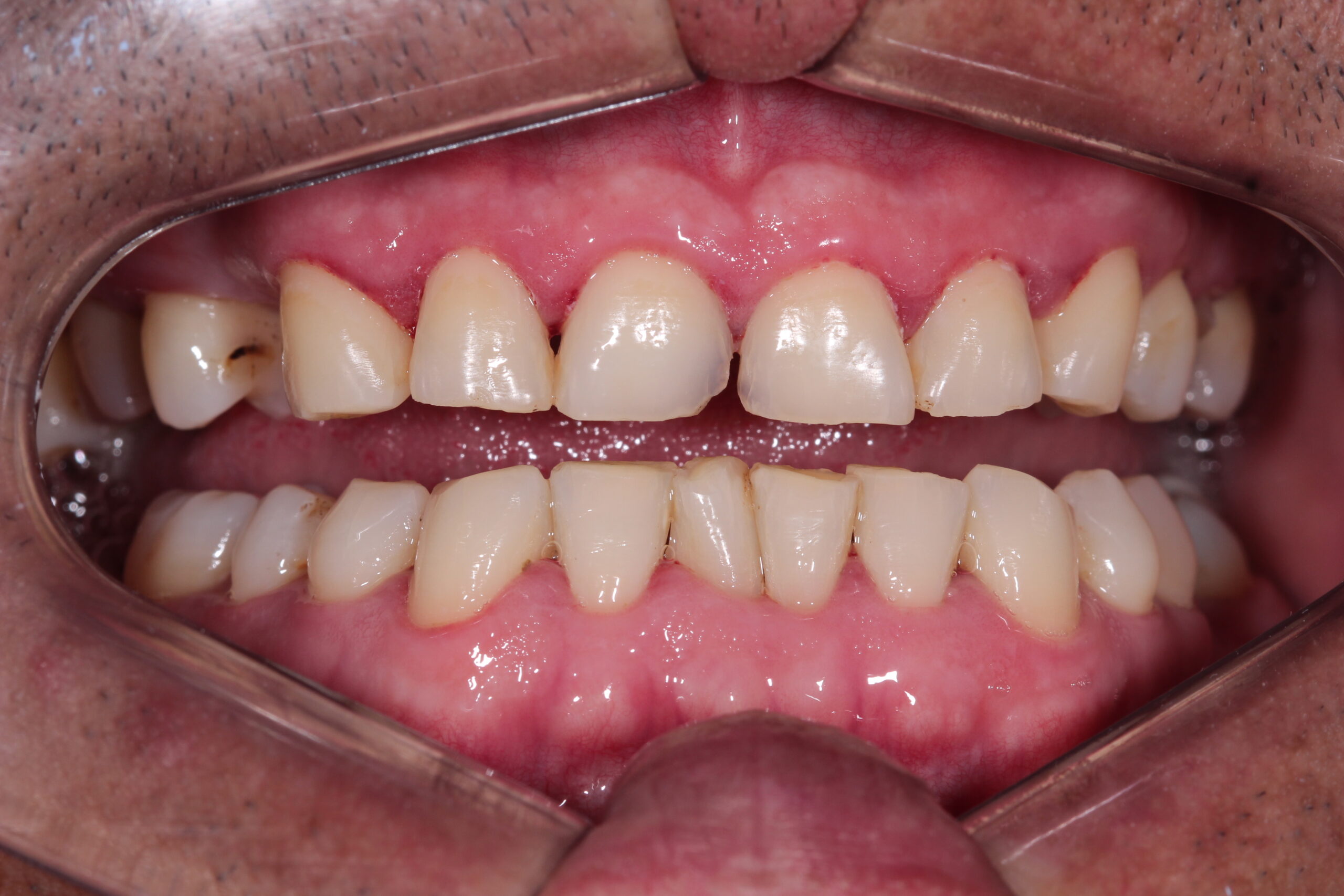 Before dental veneers and smile design with imperfections and interdental spaces.