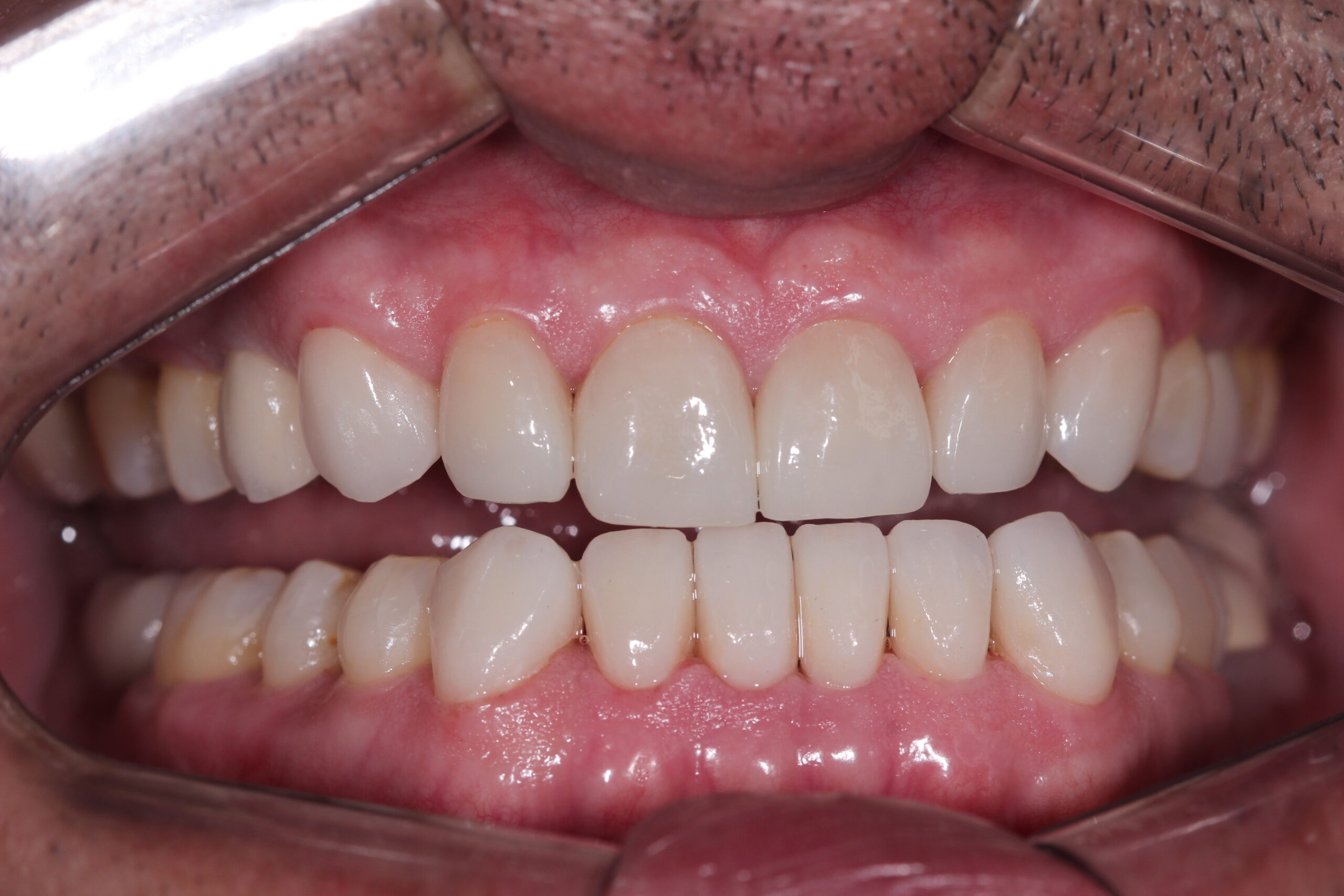 After dental veneers with a perfect, aligned, and white high-aesthetic smile.