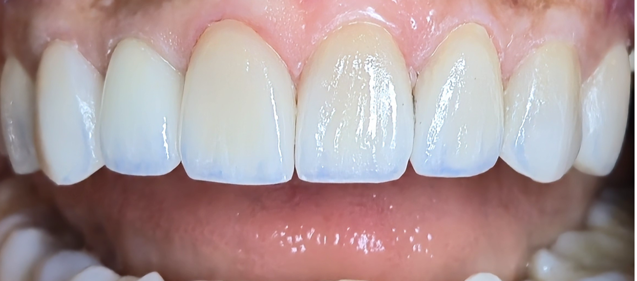 Finished pure porcelain crown with excellent aesthetics, shine, and natural color.
