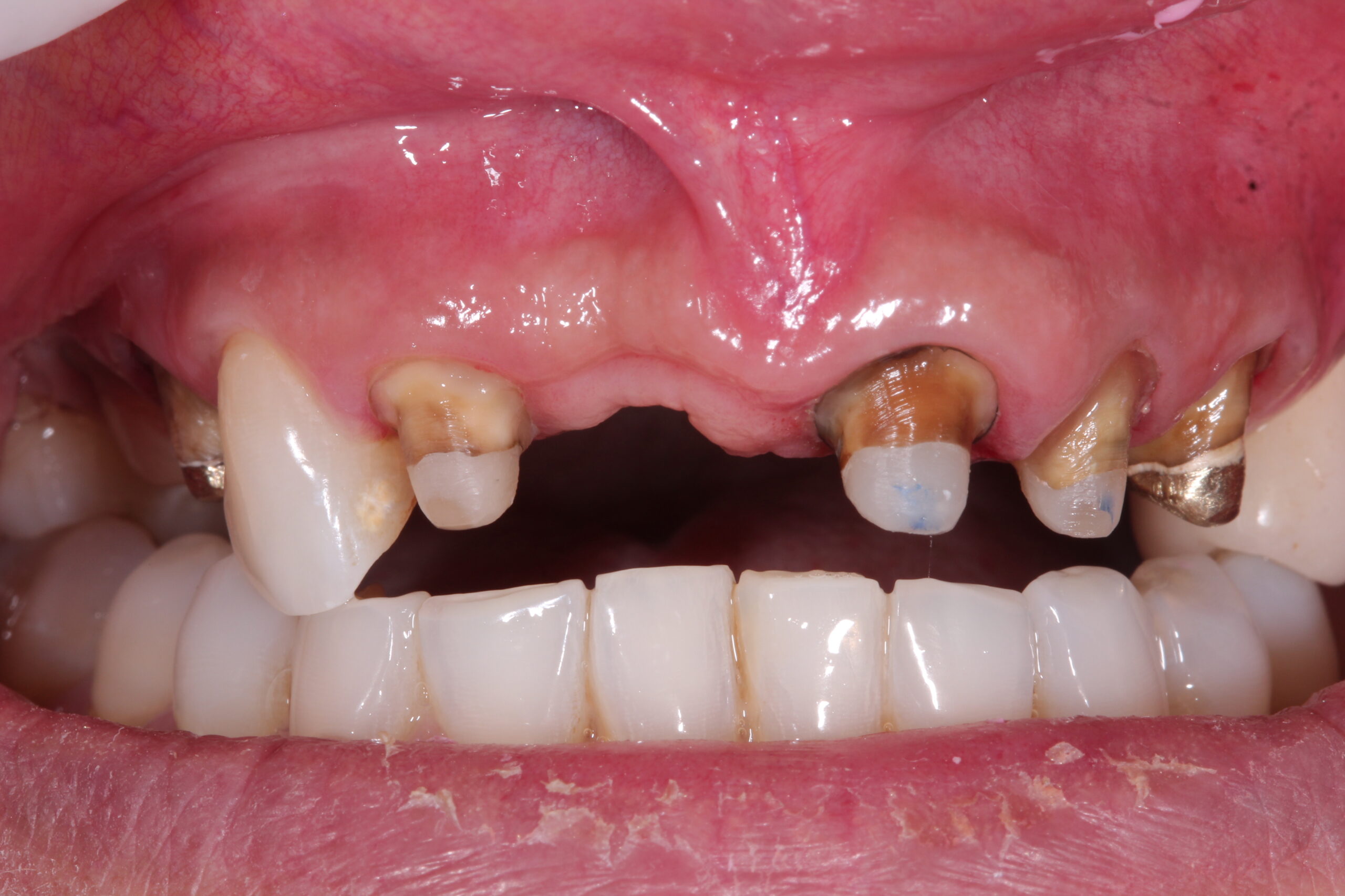 Dental preparation treatment before placing high-aesthetic porcelain crowns.