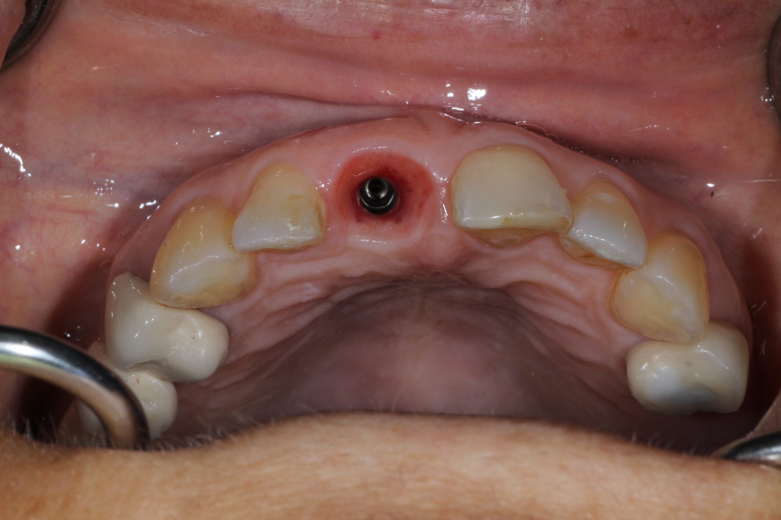 Dental implant with definitive crown on upper front tooth with natural appearance.