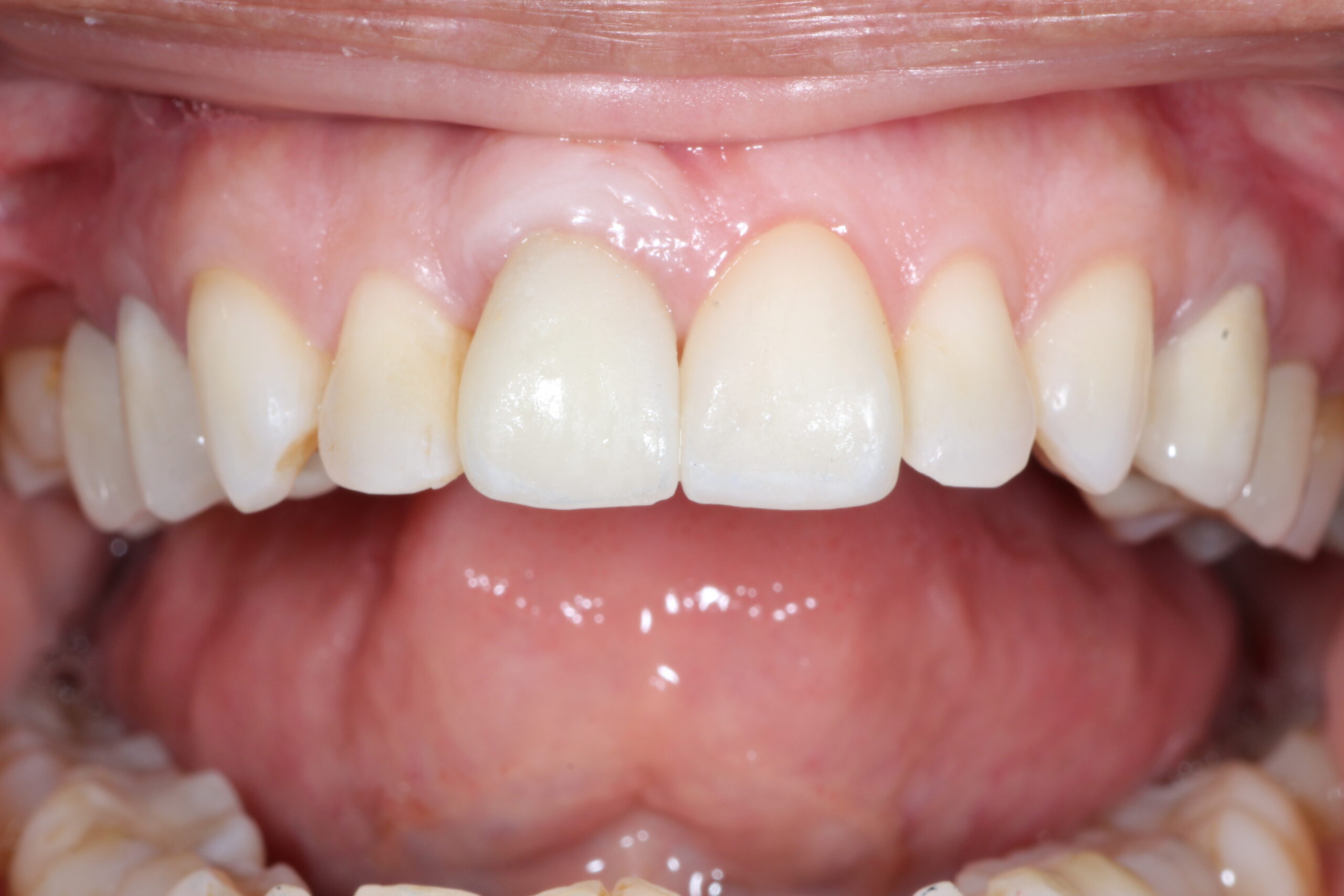 Dental implant placed in the upper jaw in healing phase without tooth.